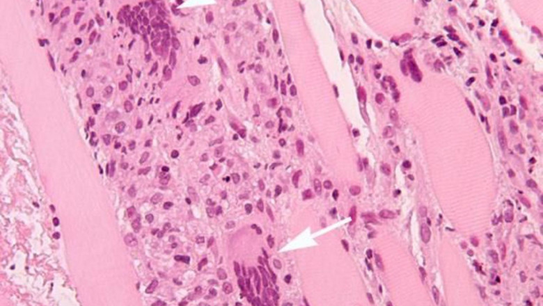 Inflammatory Myositis Diagnosis Market: Future Prospects & Growth