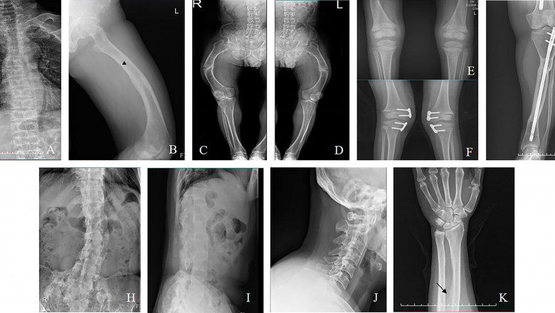 X-linked Hypophosphatemia Market Growth and Forecast Insights