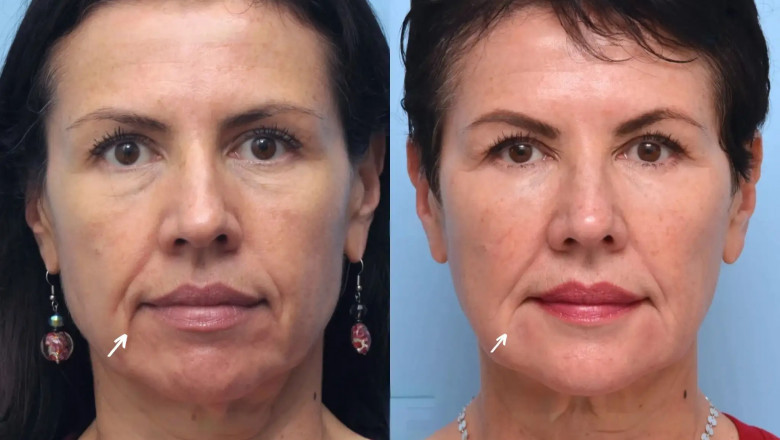 Best Aesthetic Clinics in Dubai for Botox: Achieve a Youthful, Wrinkle-Free Look