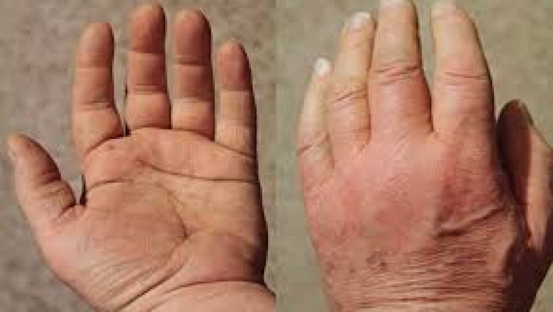 Polymyalgia Rheumatica Drugs Market Growth  Forecast Overview
