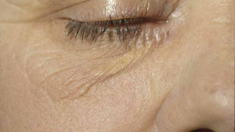 Cerebrotendinous Xanthomatosis Market Growth and Investment Dynamics