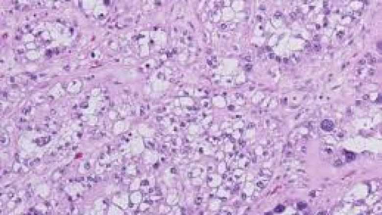Clear Cell Ovarian Cancer Market Growth and Trends Analysis