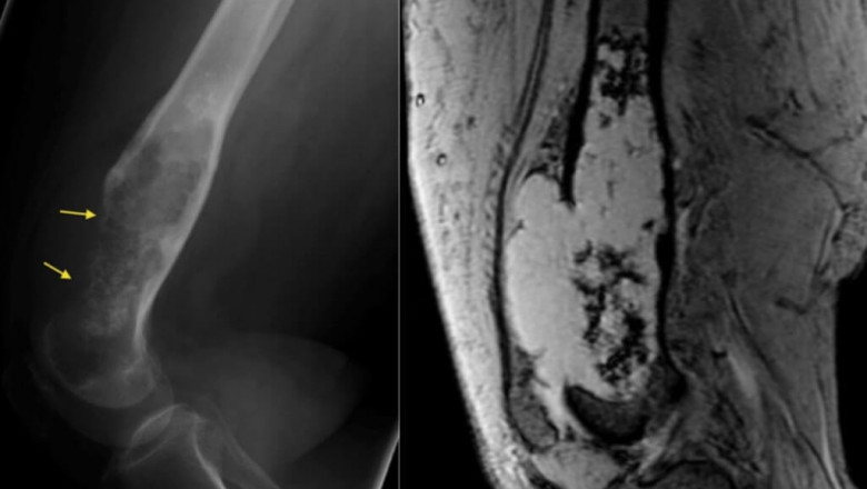 Emerging Dynamics in Chondrosarcoma Market Growth