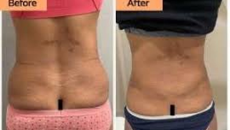 Liposuction Surgery in Gurgaon: A Comprehensive Guide by Dr. Diksha Dixit