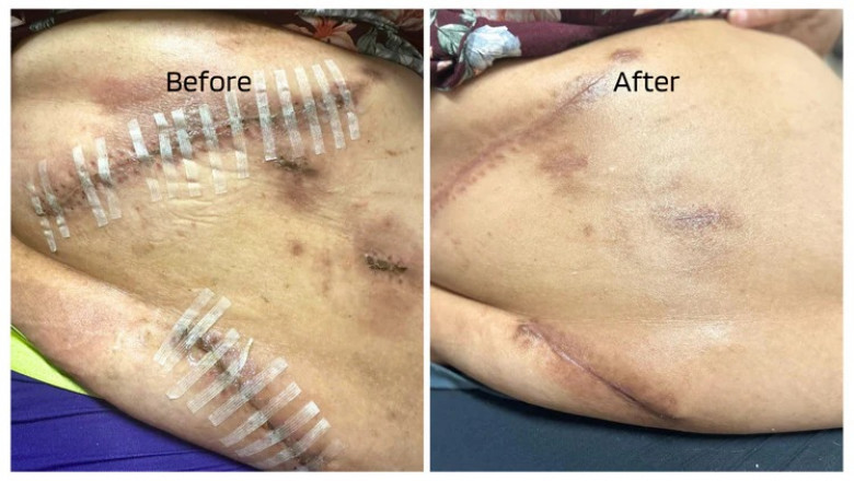 Gentle, Effective Body Creams for Eczema Relief