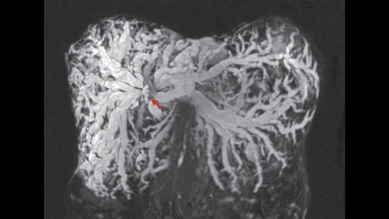 Global Intrahepatic Cholangiocarcinoma Market Prospects and Trends