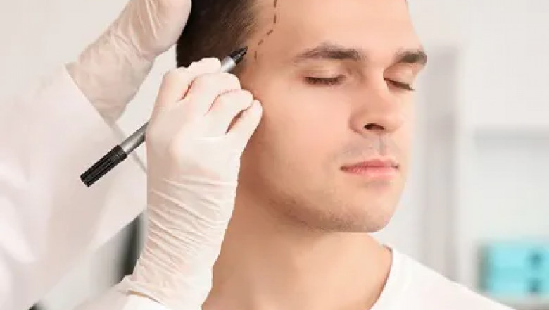 Hair Transplant London – The Ultimate Solution for Hair Loss in the Capital