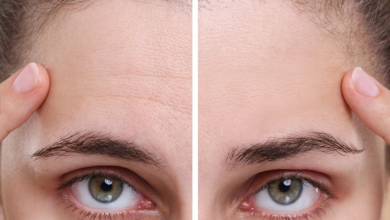 Signs It’s Time to Book a Wrinkles Treatment Near You