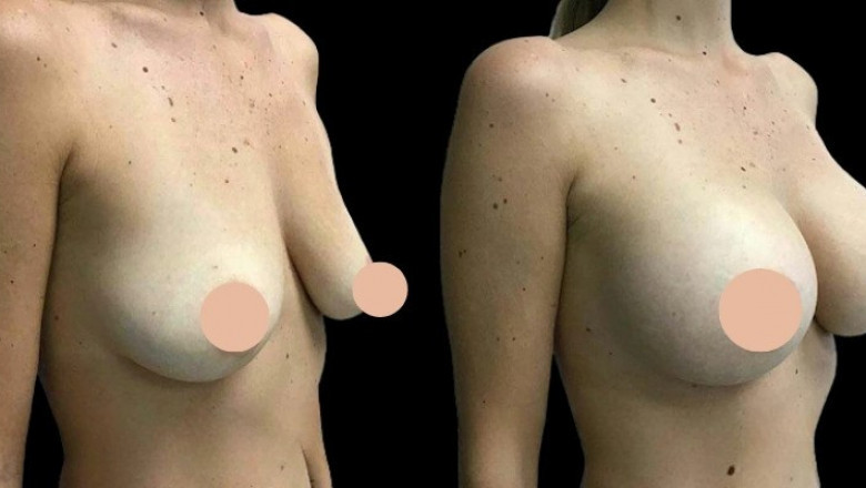 Best Breast Augmentation Surgeons in Dubai: Combining Breast Augmentation with Other Cosmetic Procedures