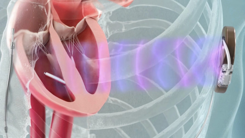 Leadless Pacemakers Market Growth and Strategic Outlook 2025-2032