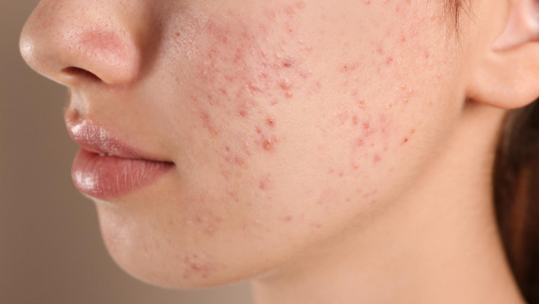 Myths About Acne: What You Should Stop Believing