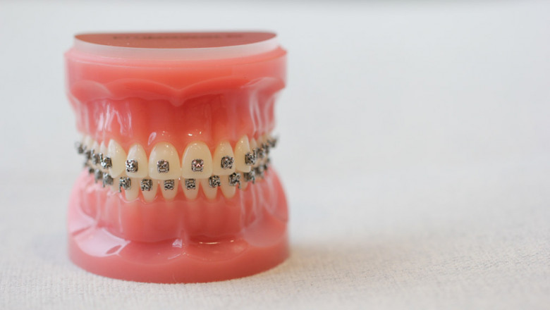 Invisalign Redmond