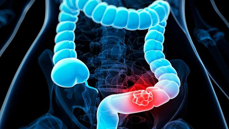 Colorectal Cancer Therapeutics Market Size, Growth, and Strategic Outlook