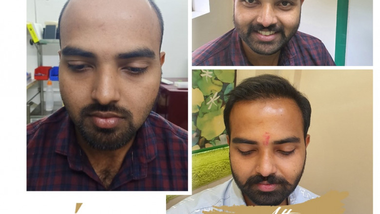From Bald to Bold: Discover the Life-Changing Confidence Boost of a Hair Transplant in Pune