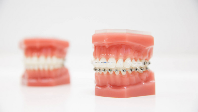 Orthodontist Markham