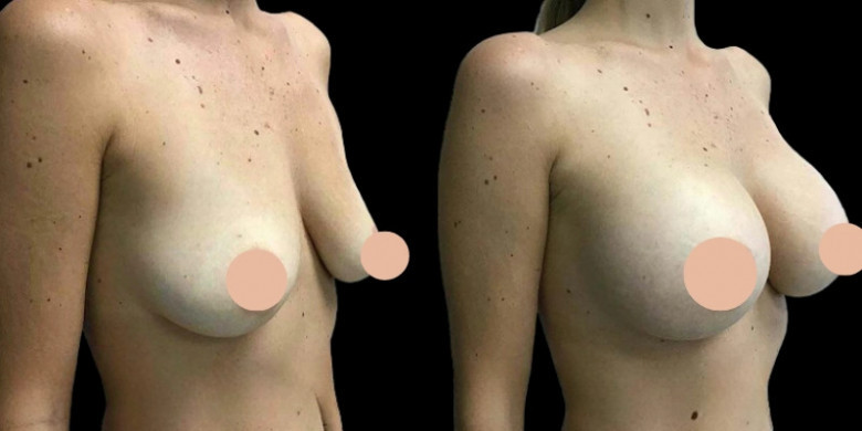 best breast augmentation doctors in Dubai