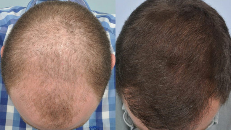 How to Choose the Best Hair Transplant Clinic in India: Expert Tips