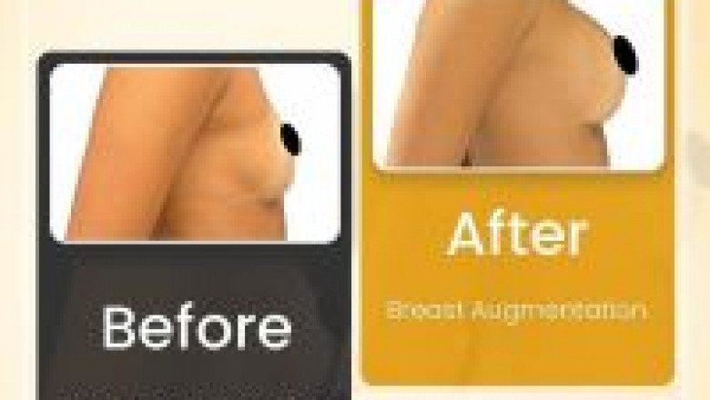 Breast Augmentation Surgery in Dubai by Dr. Hans - Renowned Plastic Surgeon