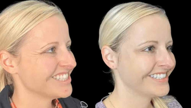 Botox in Dubai A Trusted Solution for Fine Lines and Wrinkles