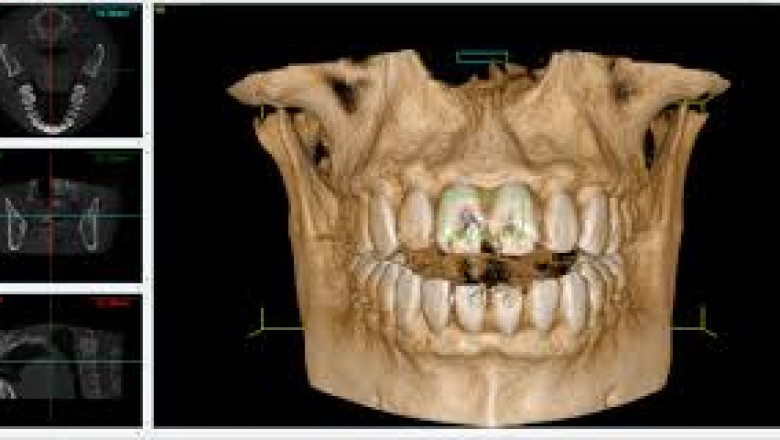 CBCT Dental Imaging Devices Market Size, Share, and Growth Outlook 2024–2032