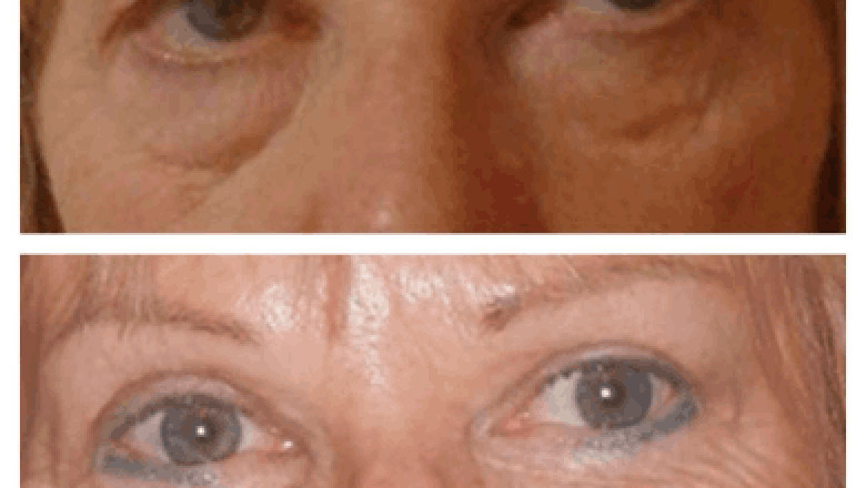 Combining Eye Bag Removal with Other Treatments: Insights from the Best Doctors in Dubai