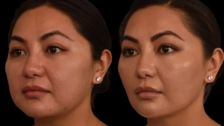 Enhancing Confidence Through Double Chin Removal with the Best Doctors in Dubai