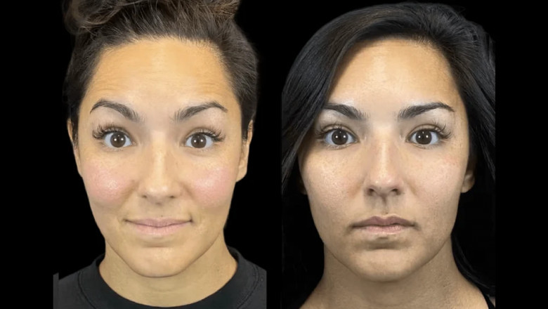 How the Best Doctors in dubai Are Revolutionizing Botox Procedures