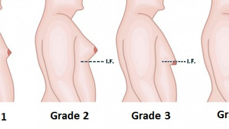 Achieving Confidence: Breast Augmentation in Islamabad