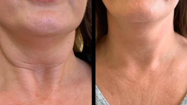 Boost Complexion Fast with Profhilo from Best Aesthetic Clinic in dubai