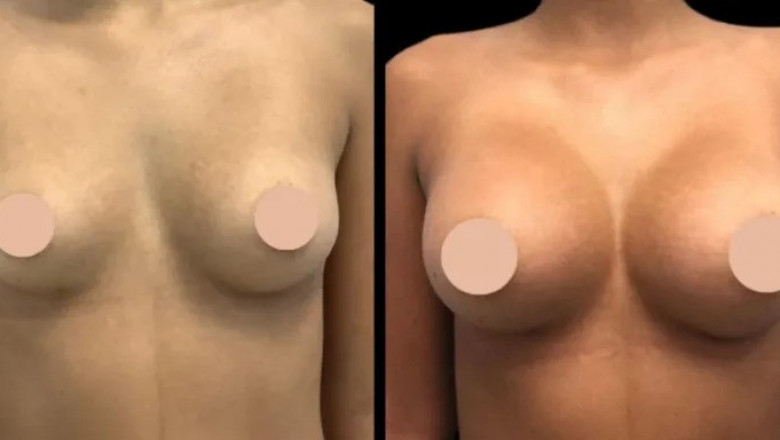 Combining Procedures with the Best Breast Enlargement Surgeons in Dubai