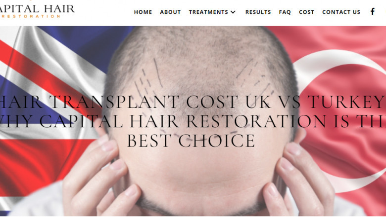 Hair Transplant Brighton and Hove – A Trusted Solution for Hair Loss