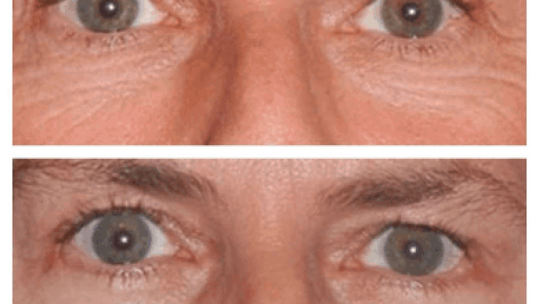 Surgical vs. Non-Surgical Eye Bag Removal: What the Best Doctors in Dubai Recommend