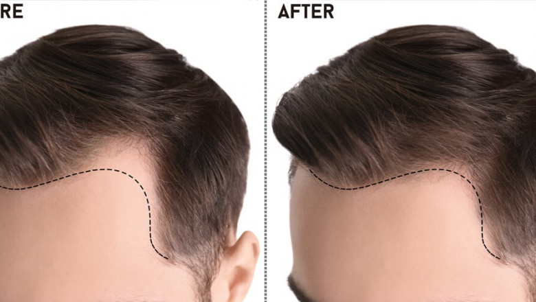 Unlocking Confidence: A Comprehensive Guide to Hair Transplants in Pakistan"