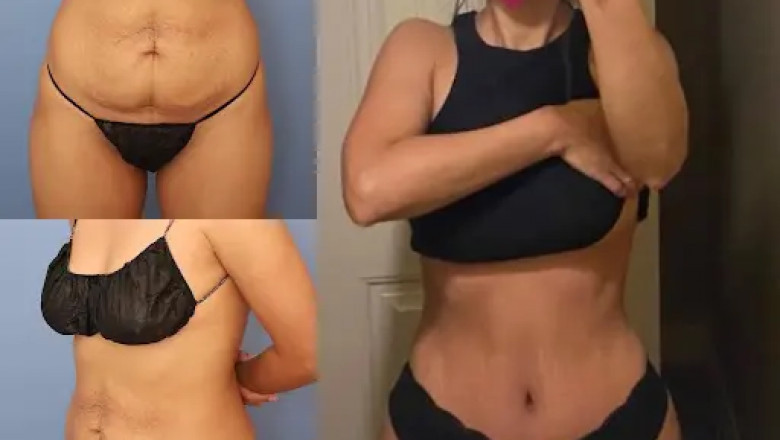 Affordable Tummy Tuck in Dubai with the Best Doctors