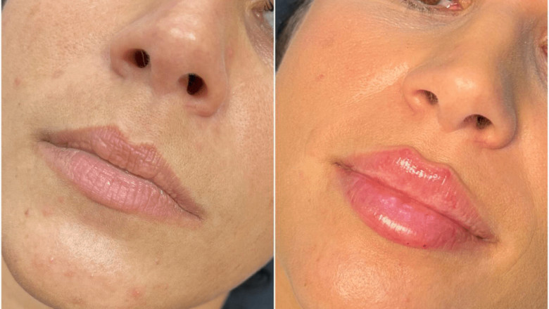 Anti-Aging Solutions: Why Choose Juvederm treatment in Dubai