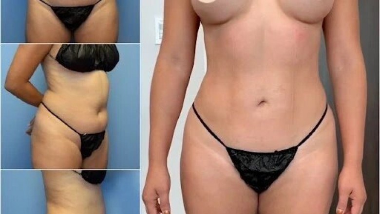 Experience the Best Body Contouring in Dubai for Stunning Results