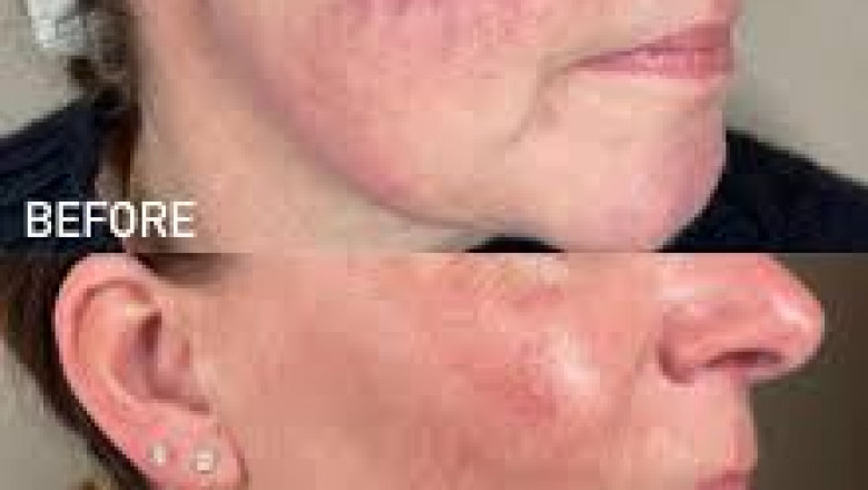 Unlock Radiant Skin with Lumecca IPL: A Comprehensive Guide