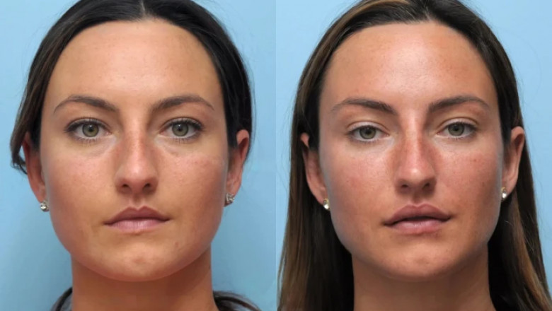 Thread Lift Treatments in Dubai Before and After Expectations
