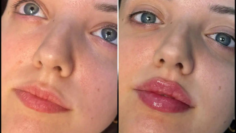 Why Fillers Treatments in Dubai Are More Popular Than Ever