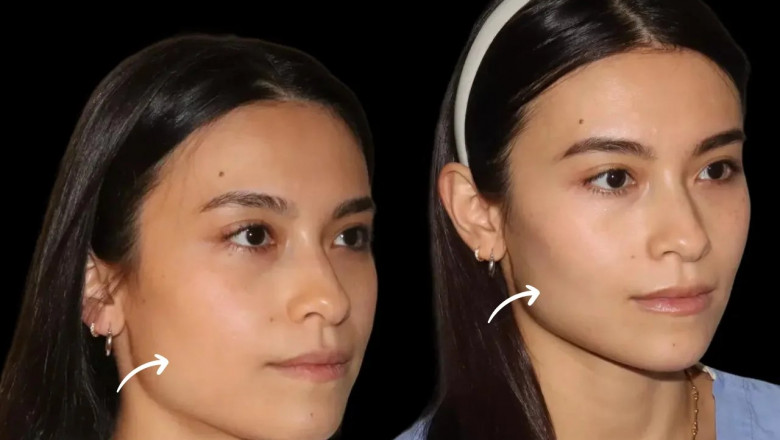 Millennials and Sculptra Fillers: What the Best Doctors in Dubai Are Noticing