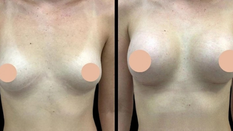 The Importance of a Consultation for Breast Augmentation in Dubai: What to Expect