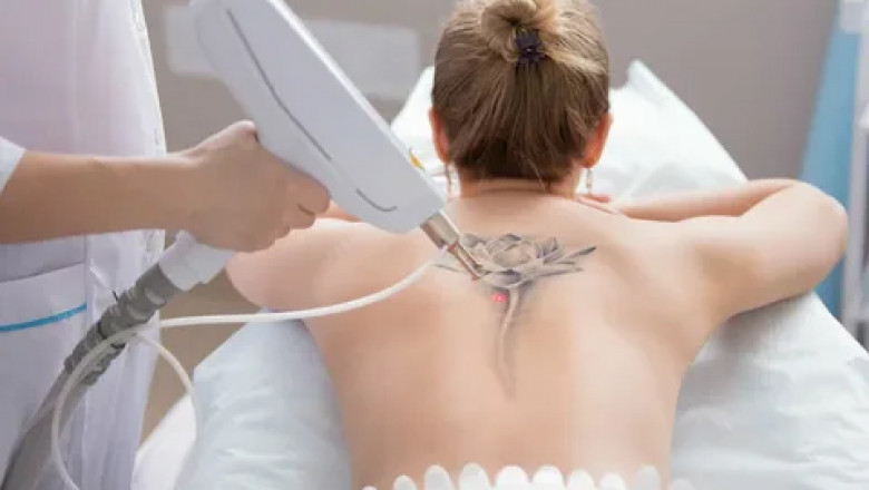 Laser Tattoo Removal: What You Need to Know Before Saying Goodbye to Your Ink
