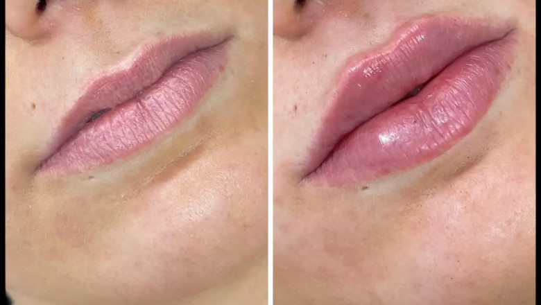 The Best Plastic Surgeons in Dubai on Russian Lip Fillers for Lip Shape Correction