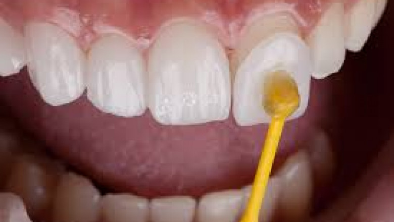 Dental Ceramic Market regional insights focusing on North America and Europe