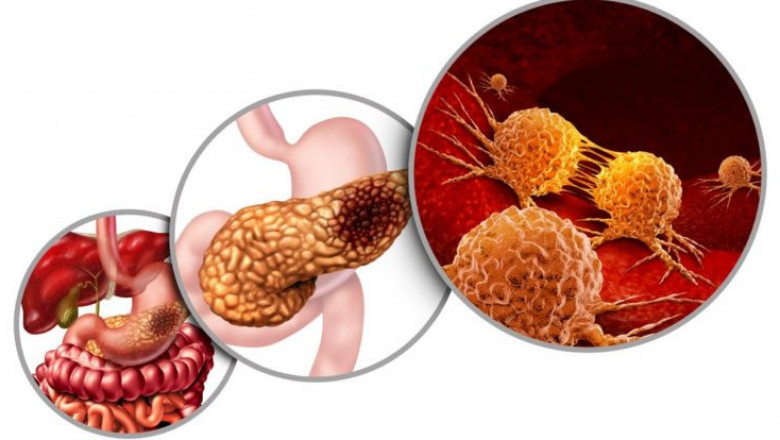 Best Pancreatic Cancer Treatment Hospitals in Bangalore