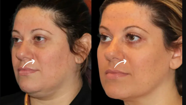 Patient Reviews: Best Aesthetic Clinics in Dubai Using Sculptra Fillers