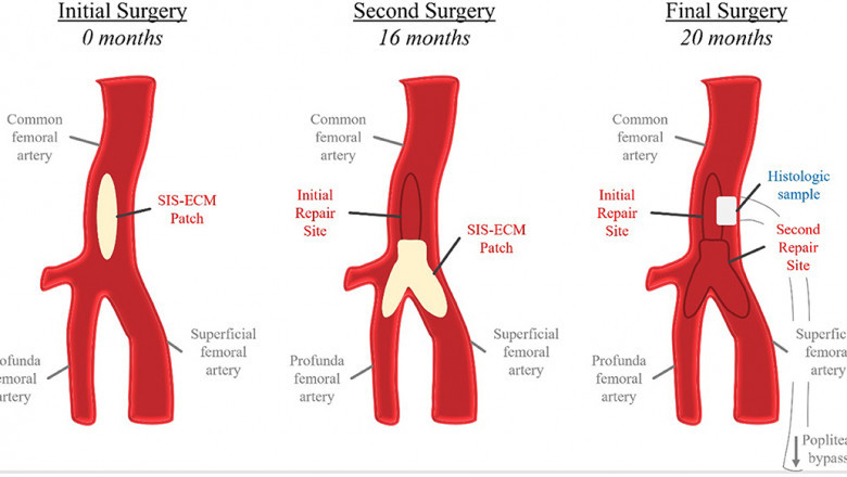 Vascular Patches Market Challenges Include Cost Barriers, Regulatory Delays, and Limited Access to Surgical Expertise