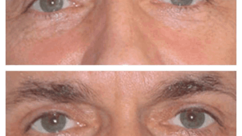 Eye bag removal in Dubai vs DIY eye masks