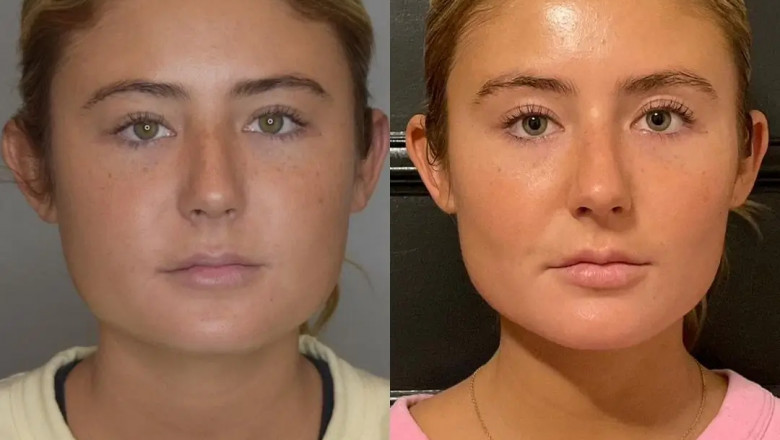 Why Younger Adults Choose Buccal fat removal in Dubai