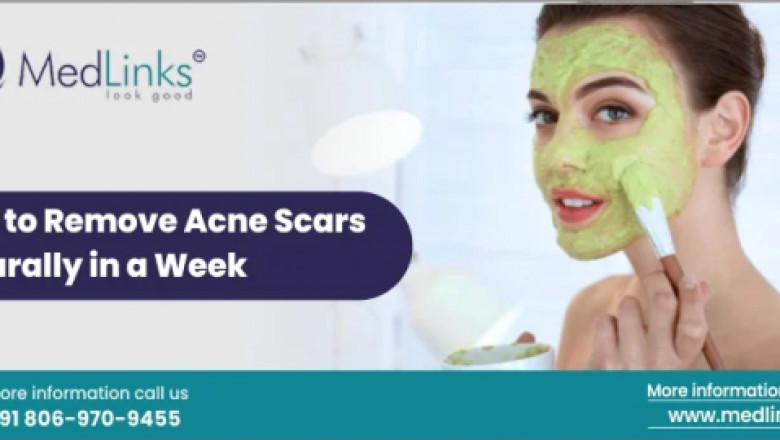 How to Remove Acne Scars Naturally in a Week: A Complete Guide by MedLinks